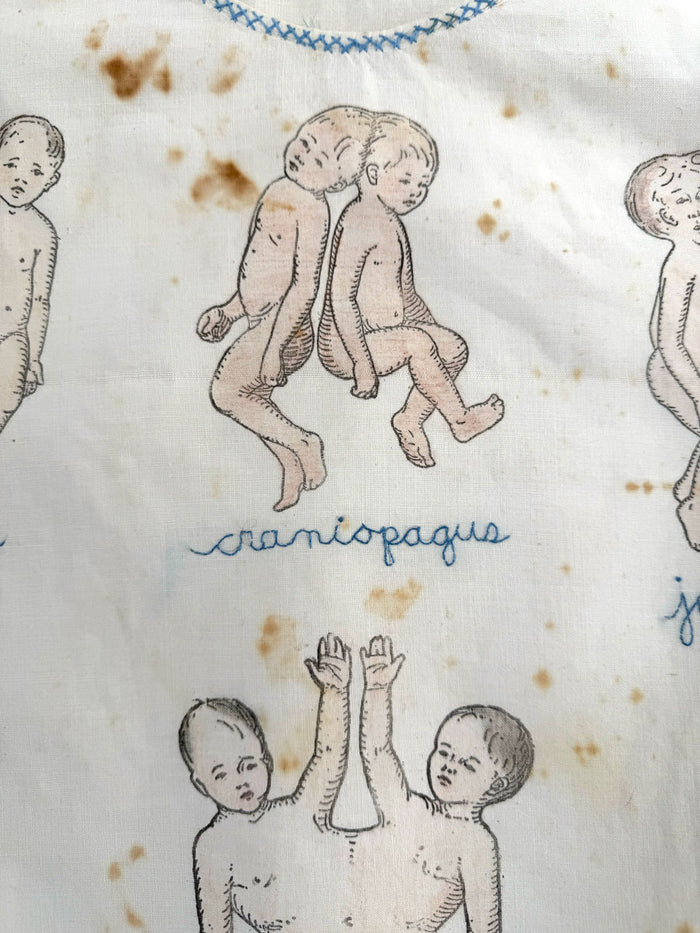 75. Conjoined Twins
